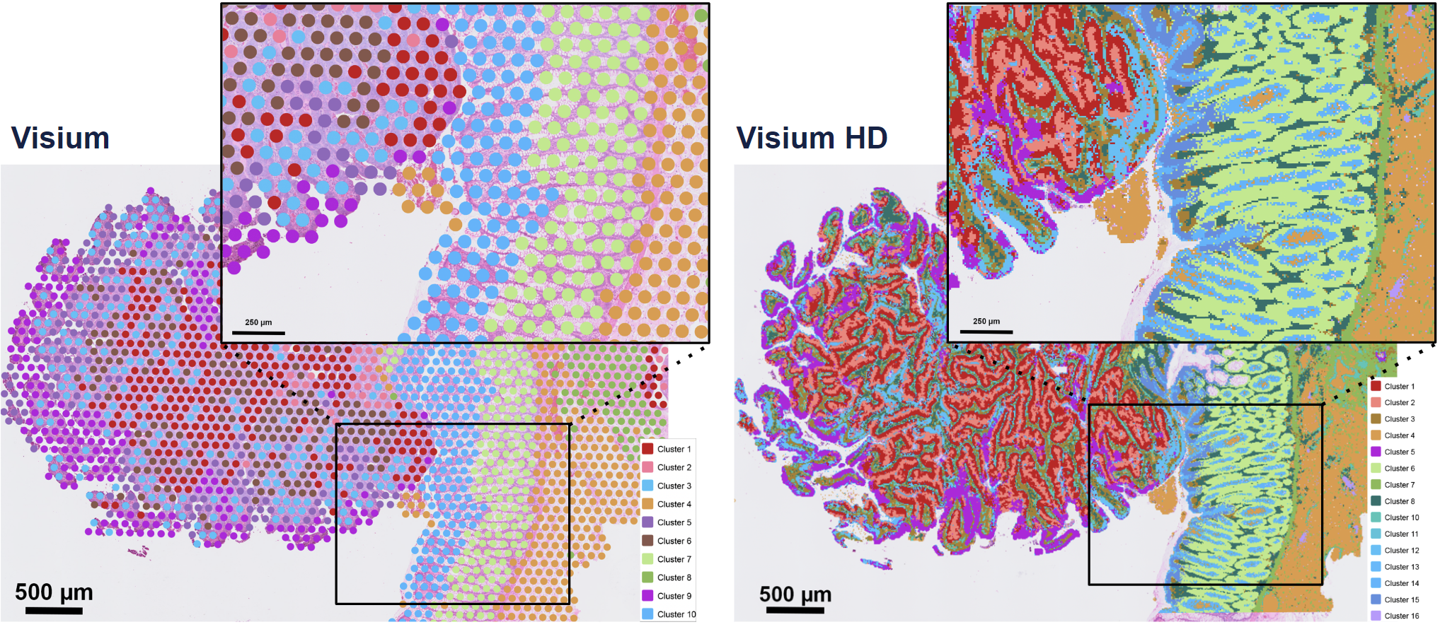 Visium v2 data (left) and Visium HD data (right) in FFPE human colorectal cancer. Credit 10Xgenomics.com